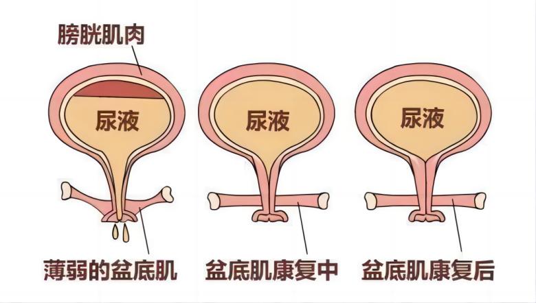 羽豐醫(yī)療丨如何有效運(yùn)用振動(dòng)提高盆底肌肉激活水平？